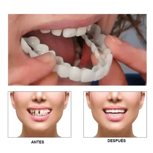 Carillas Dentales Snapon Smile