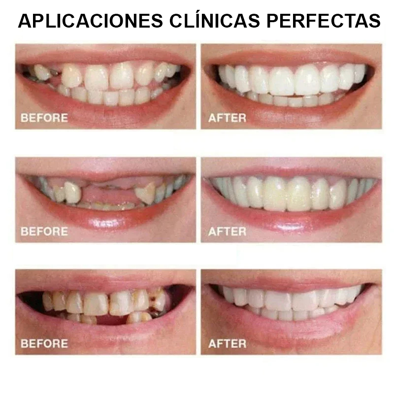 Carillas Dentales Snapon Smile